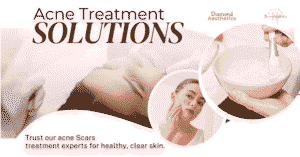 Best Skin Treatments for Acne Scars