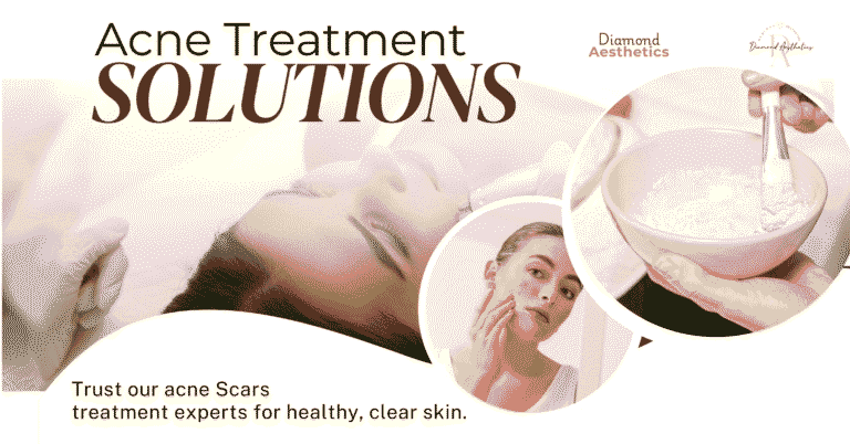 Best Skin Treatments for Acne Scars