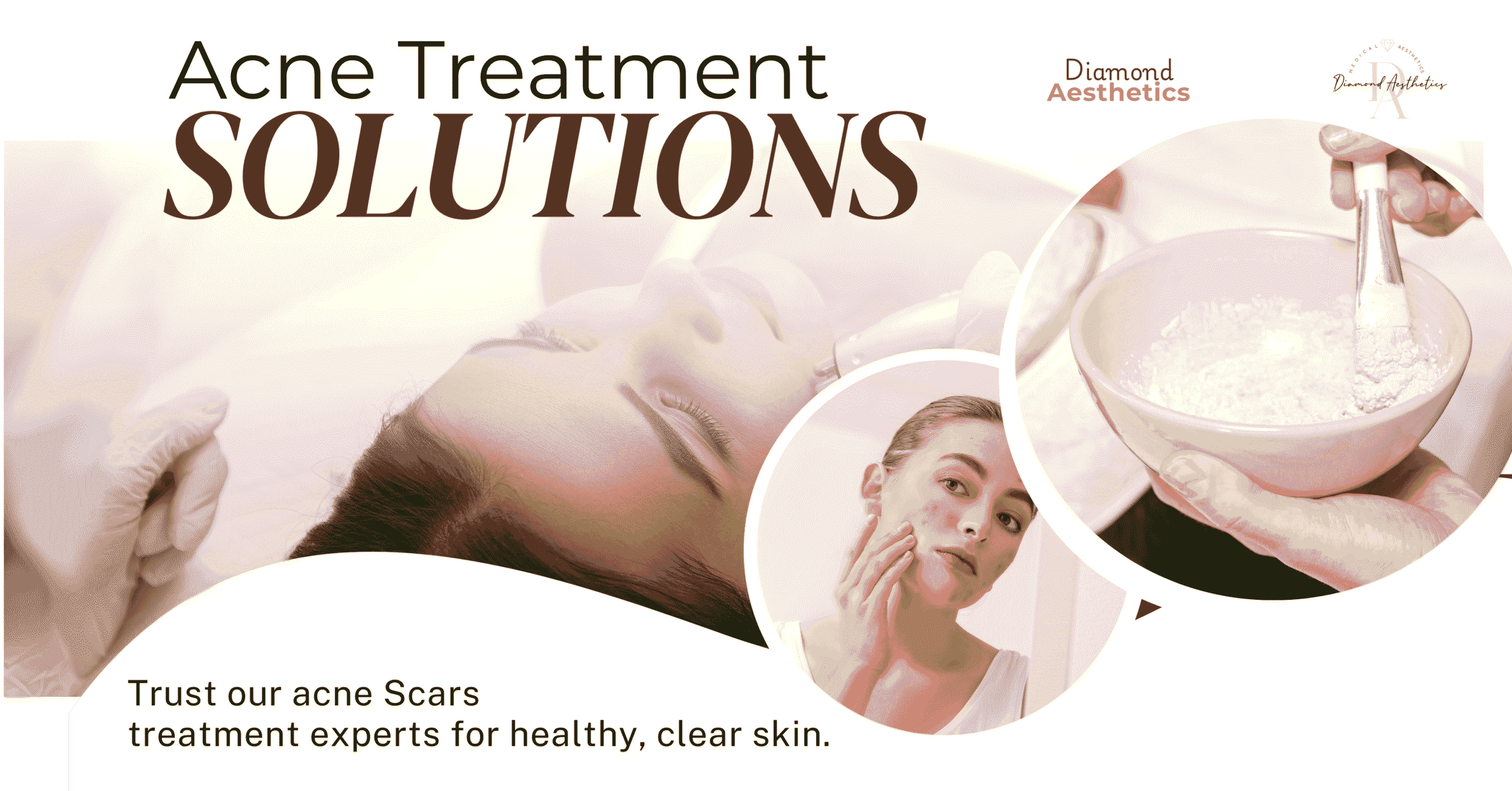 Best Skin Treatments for Acne Scars