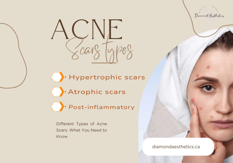 True Scars How to Remove Acne Scars: Best Treatments in Brampton