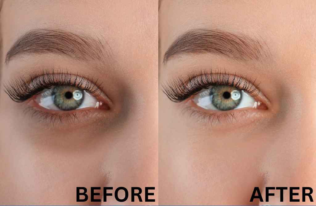 Under-Eye Laser Treatment Results: Before and After Insights