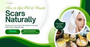 How to Get Rid of Pimple Scars Overnight Naturally Fast & Safe Home Remedies