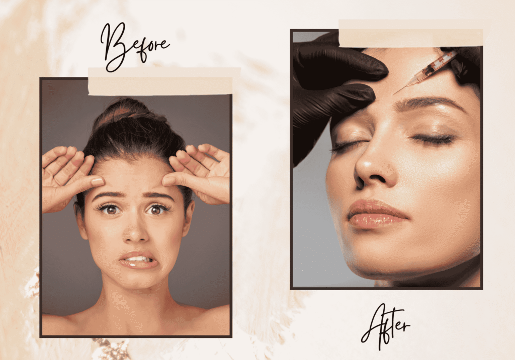 Common Side Effects of Botox on Forehead