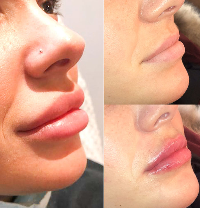 Dermal Fillers in Brampton 11 Filler Dissolving