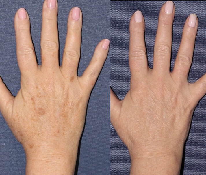 Dermal Fillers in Brampton 9 Hand Rejuvenation