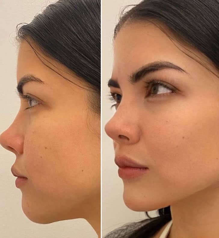 Dermal Fillers in Brampton 6 Jawline Contouring
