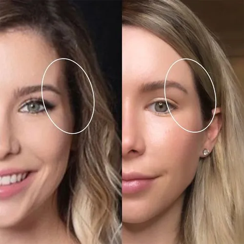 Dermal Fillers in Brampton 7 Temple Fillers