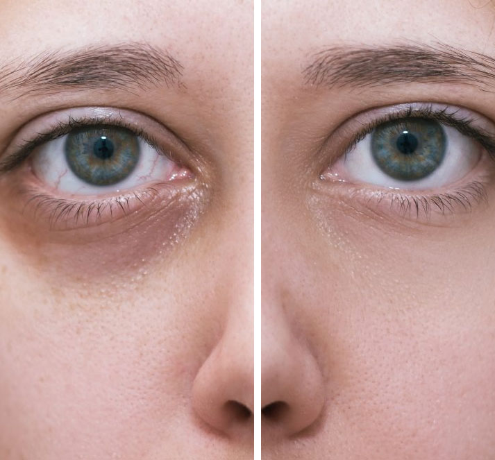 Dermal Fillers in Brampton 8 Under Eye Filler