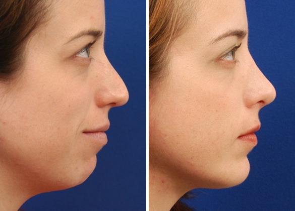 Dermal Fillers in Brampton 5 chin augmentation 1