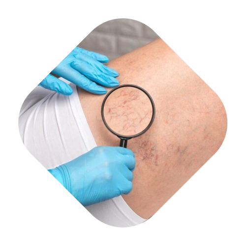 Sclerotherapy - Pricing 1 image 142