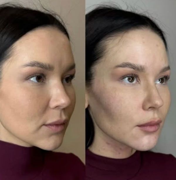 Dermal Fillers in Brampton 3 nasolabial folds filler