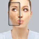 dark marks (hyperpigmentation)