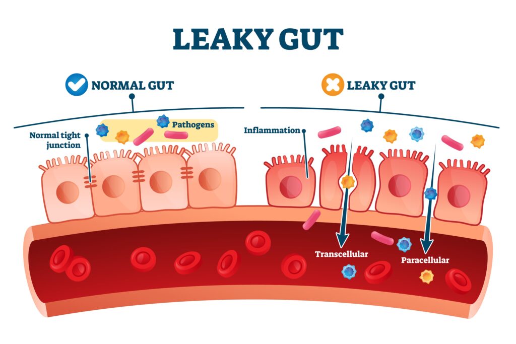 How to Fix Gut Health: The Clinical & Natural Roadmap 2 Diagram comparing a healthy intestinal lining with tight junctions to leaky gut syndrome showing increased intestinal permeability and systemic inflammation.